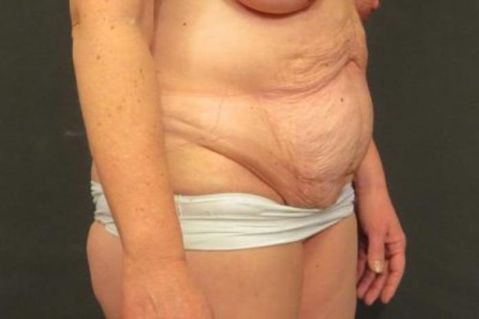 Case #324 – Tummy Tuck