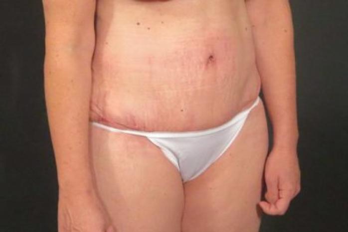 Case #324 – Tummy Tuck
