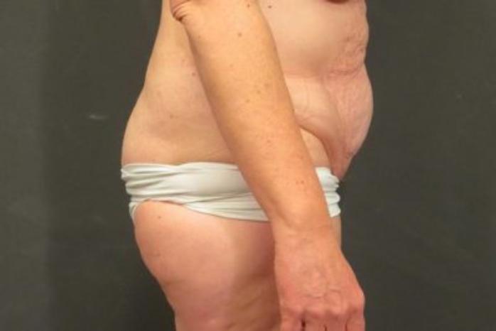 Case #324 – Tummy Tuck