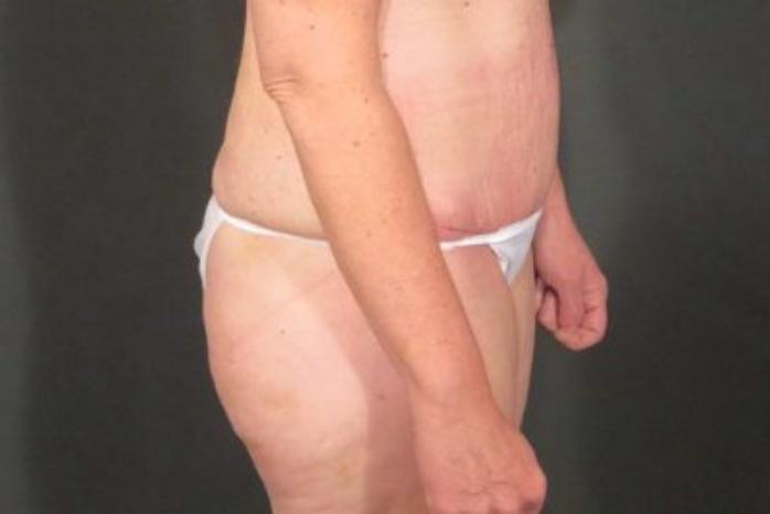 Case #324 – Tummy Tuck