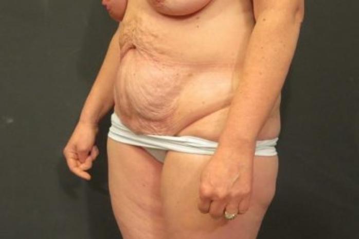 Case #324 – Tummy Tuck