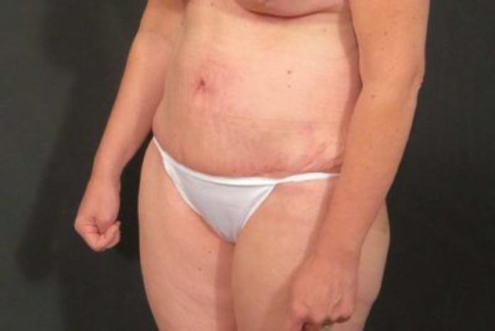 Case #324 – Tummy Tuck