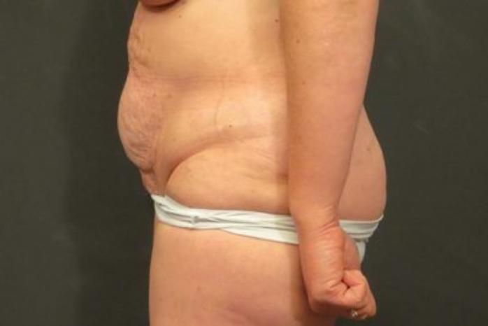Case #324 – Tummy Tuck