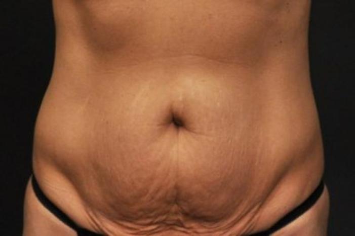 Case #94 – Tummy Tuck
