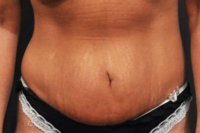 Case #94 – Tummy Tuck