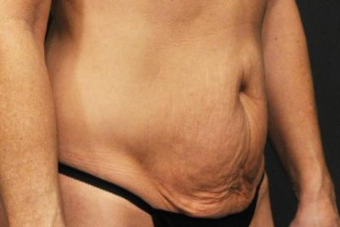 Case #94 – Tummy Tuck