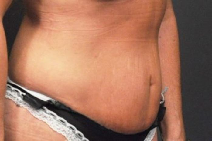 Case #94 – Tummy Tuck