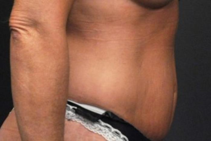 Case #94 – Tummy Tuck