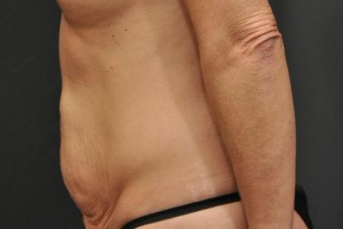 Case #94 – Tummy Tuck