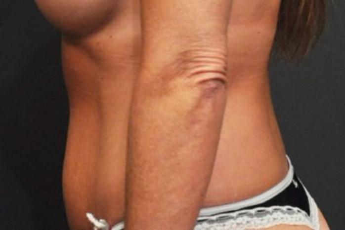 Case #94 – Tummy Tuck