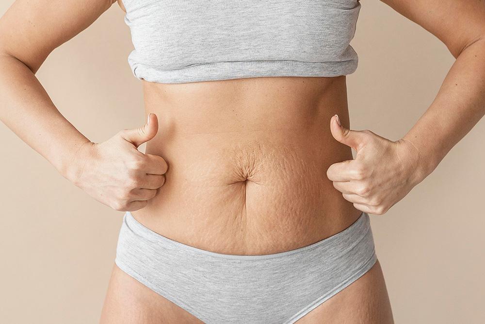 if a Mini Abdominoplasty is Right for You