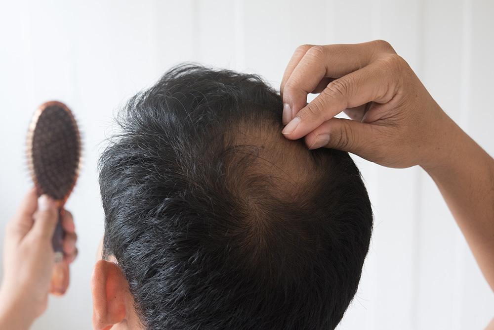 Study Latisse for Baldness