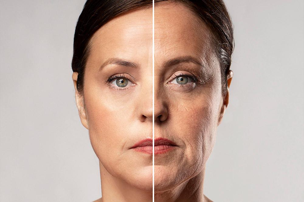 Facial Aging