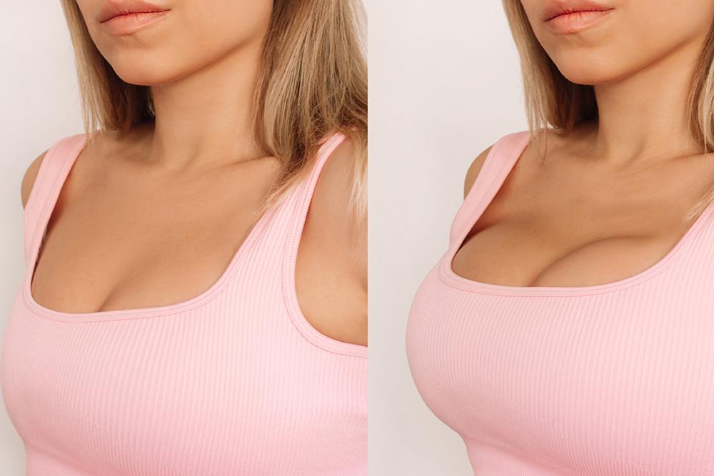 breast augmentation