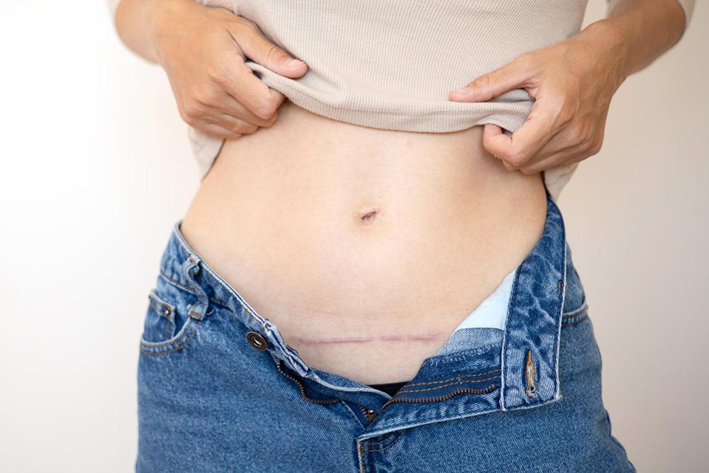 Tummy Tuck With Bladder Surgery