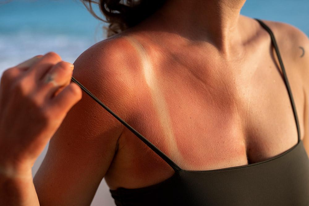 Five Effective Methods for Preventing Sunburn