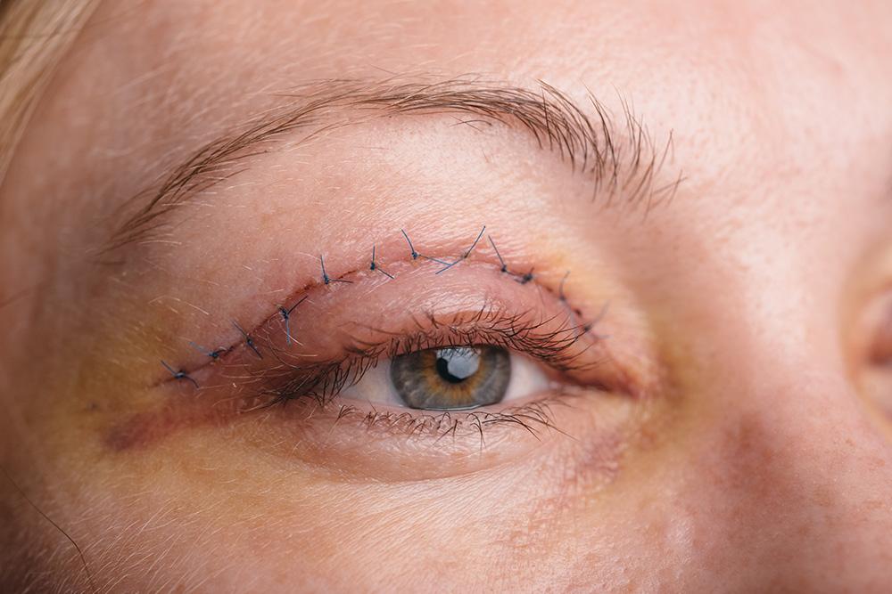 Cosmetic Eyelid
