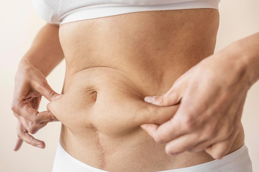 Tummy Tuck with Liposuction