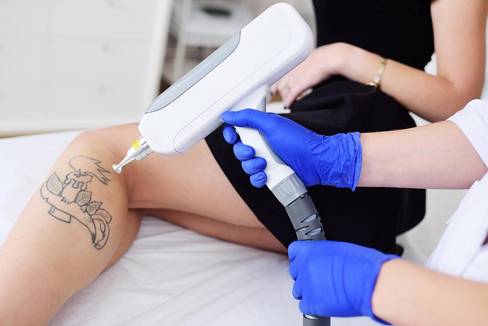 Laser Tattoo Removal Procedures