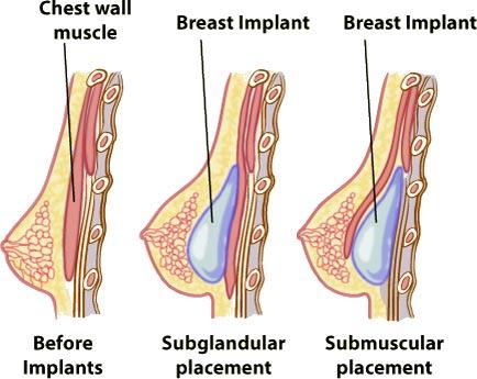 En qué consiste el implante