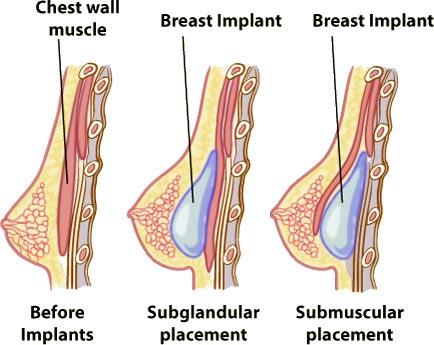 🥇 Breast Augmentation: Which breast implant is best for me