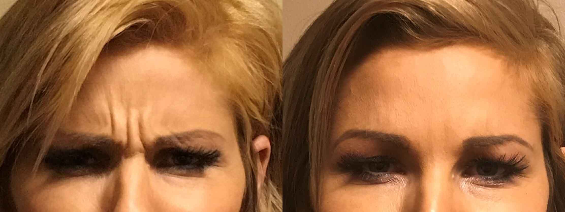 A before and After Comparison of a patient who received a botox treatment at seattle plastic surgery