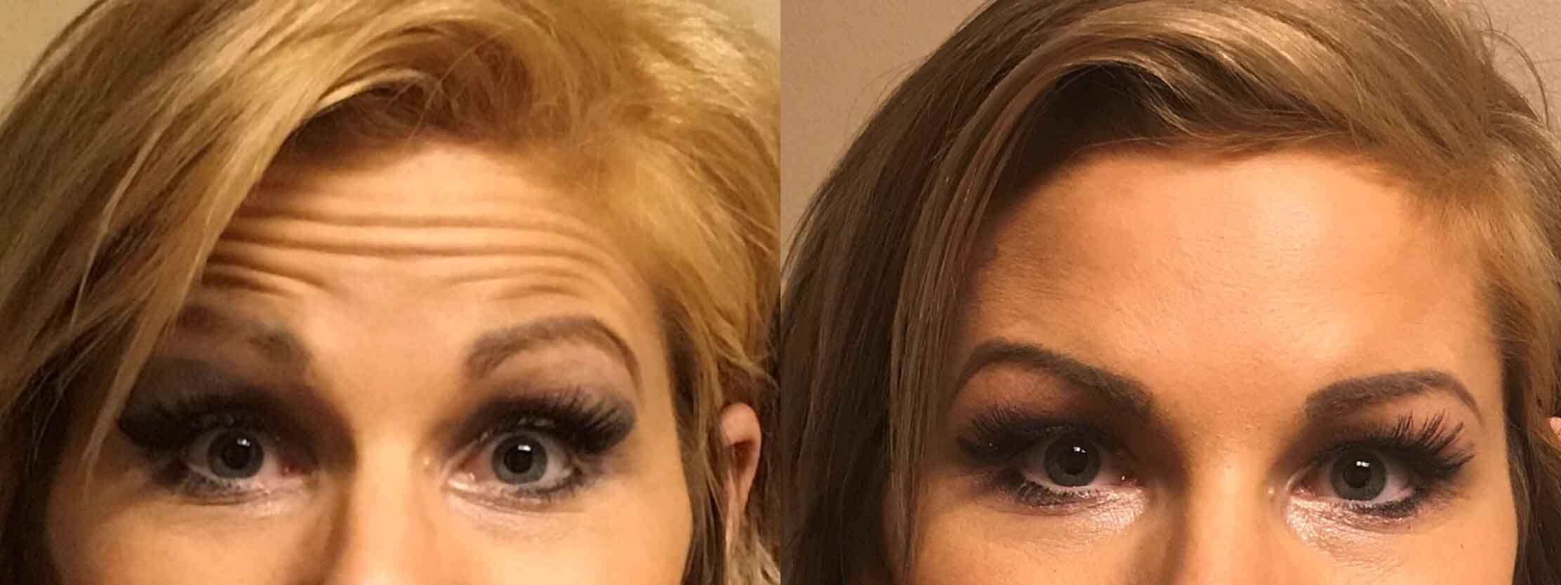 A before and After Comparison of a patient who received a botox treatment at seattle plastic surgery