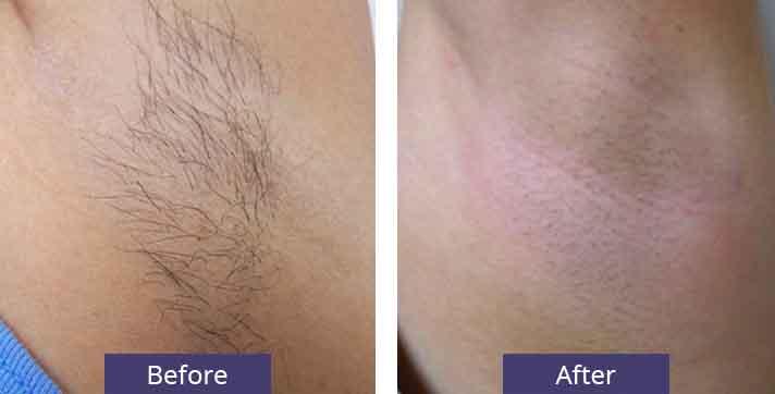 Laser Hair Removal Seattle | Hair Removal Cost | Seattle Plastic Surgery