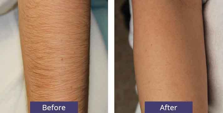 30 Minute Can you workout before laser hair removal for Burn Fat fast