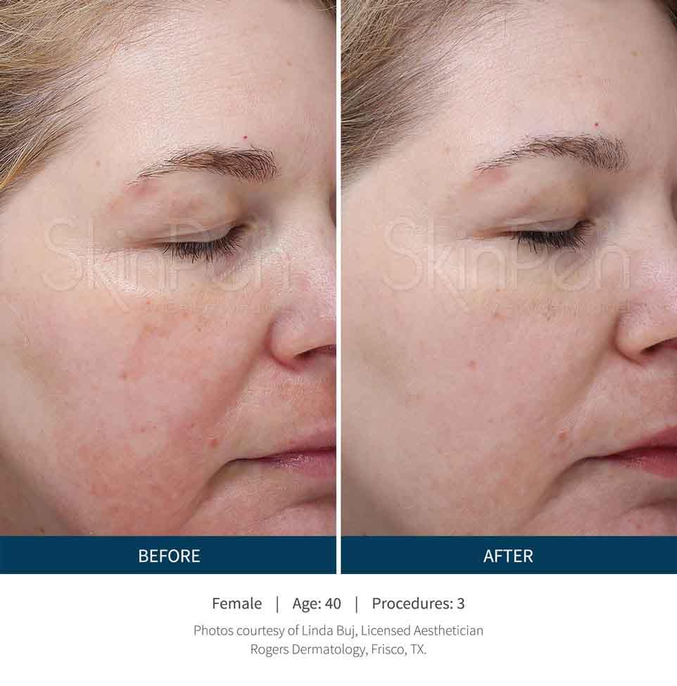 A Before and After Microneedling treatment in Seattle