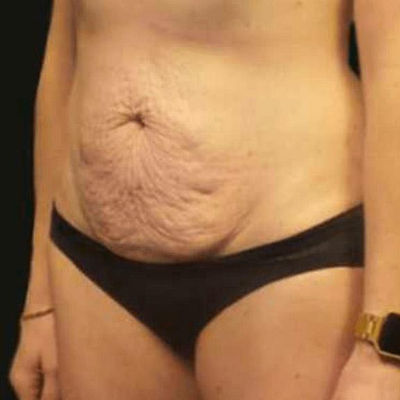 A Before photo of a Tummy Tuck Plastic Surgery by Dr. Craig Jonov