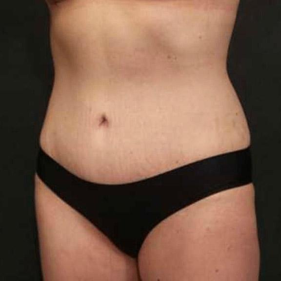An After photo of a Tummy Tuck Plastic Surgery by Dr. Craig Jonov