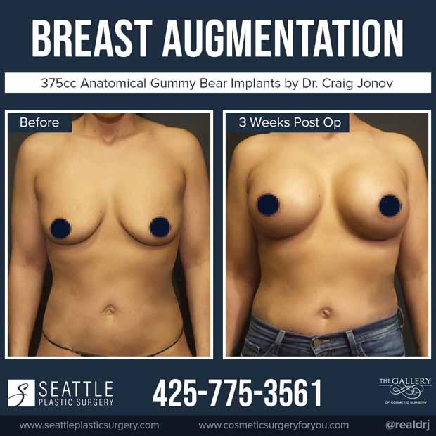 Fresh Fresco photo of a Breast Augmentation 375cc anatomical gummy bear implants by Dr. Jonov.