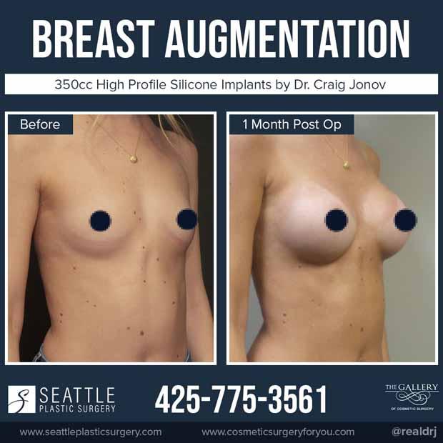 A Before and After of a Breast Augmentation Plastic Surgery by Dr. Craig Jonov