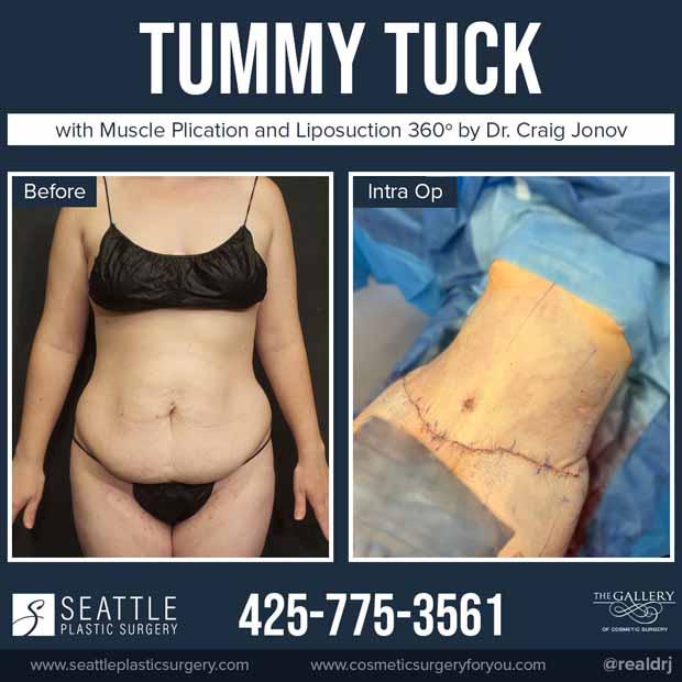 Fresh Fresco image of Tummy Tuck with Muscle Plication and Liposuction by Dr. Craig Jonov