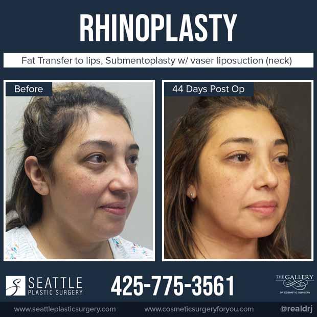 Fresh Fresco photo of a Rhinoplasty, fat transfer to lips, submentoplasty with vaser liposuction neck.