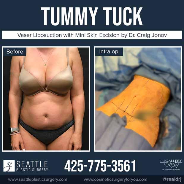 Fresh Fresco photo of a Tummy Tuck, vaser liposuction with Mini Skin Excision by Dr. Jonov