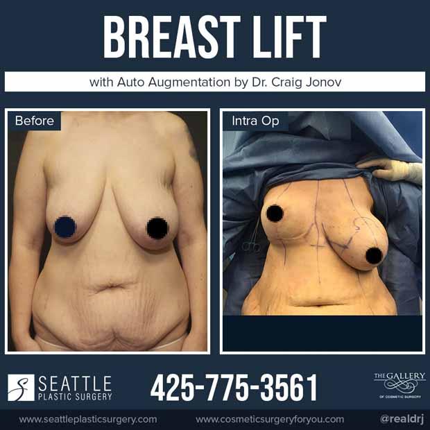 Intra op photo of a Breast Lift Plastic Surgery by Dr. Craig Jonov