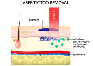 Illustration Laser Tattoo Removal in Seattle and Tacoma