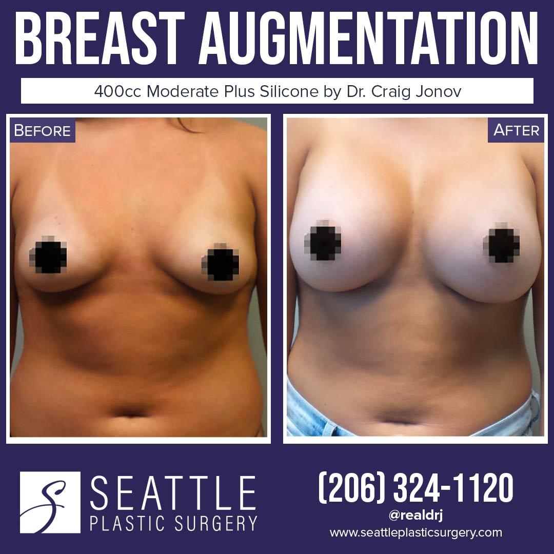 A Before and After photo of a Breast Augmentation Plastic Surgery by Dr. Craig Jonov