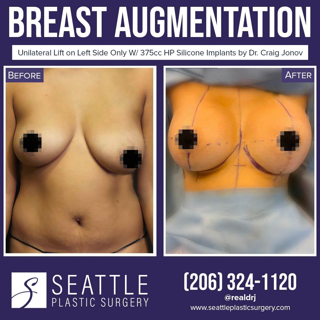 A Before and After photo of a Breast Augmentation Plastic Surgery by Dr. Craig Jonov