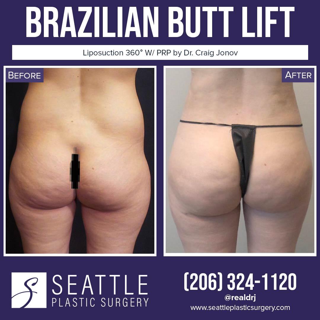 A Before and After photo of a Brazilian Butt Lift Plastic Surgery With Liposuction by Dr. Craig Jonov