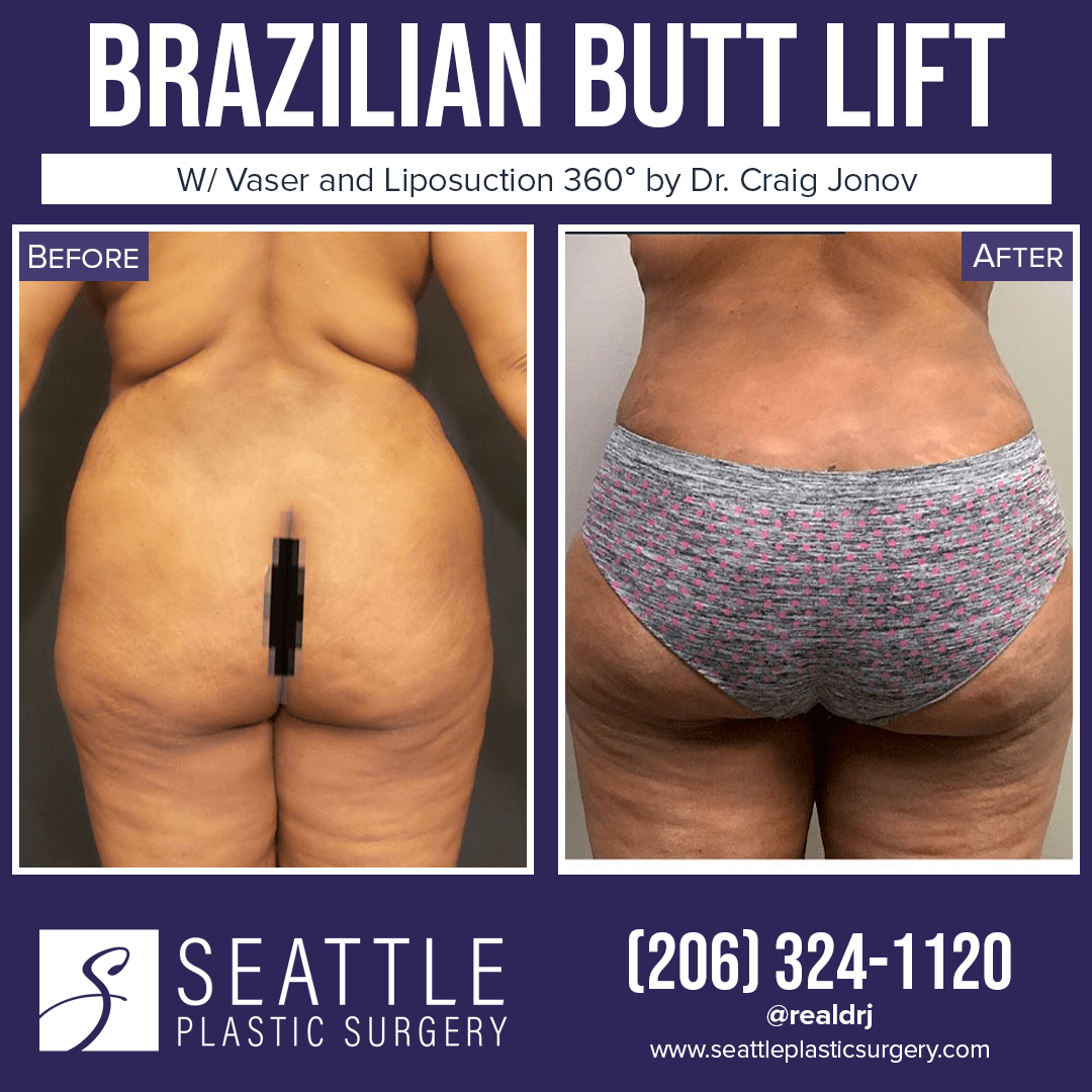 A Before and After photo of a Brazilian Butt Lift Plastic Surgery With Liposuction by Dr. Craig Jonov