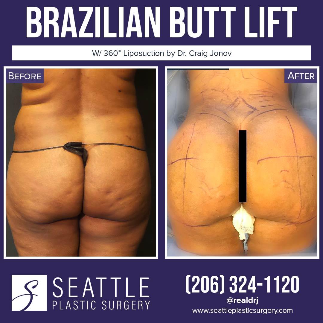 A Before and After photo of a Brazilian Butt Lift Plastic Surgery With Liposuction by Dr. Craig Jonov