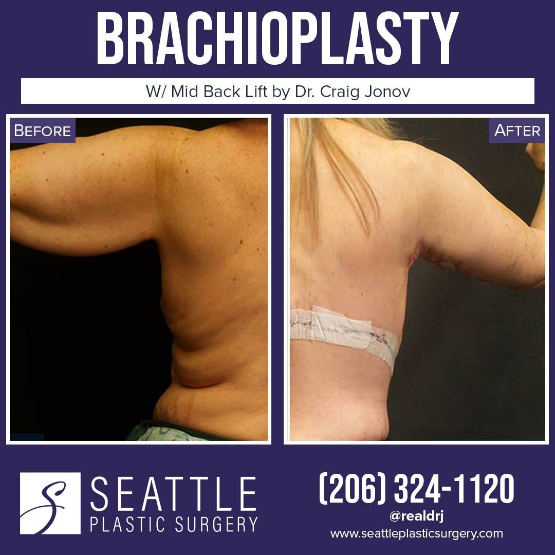 A Before and After photo of a Brachioplasty Plastic Surgery by Dr. Craig Jonov