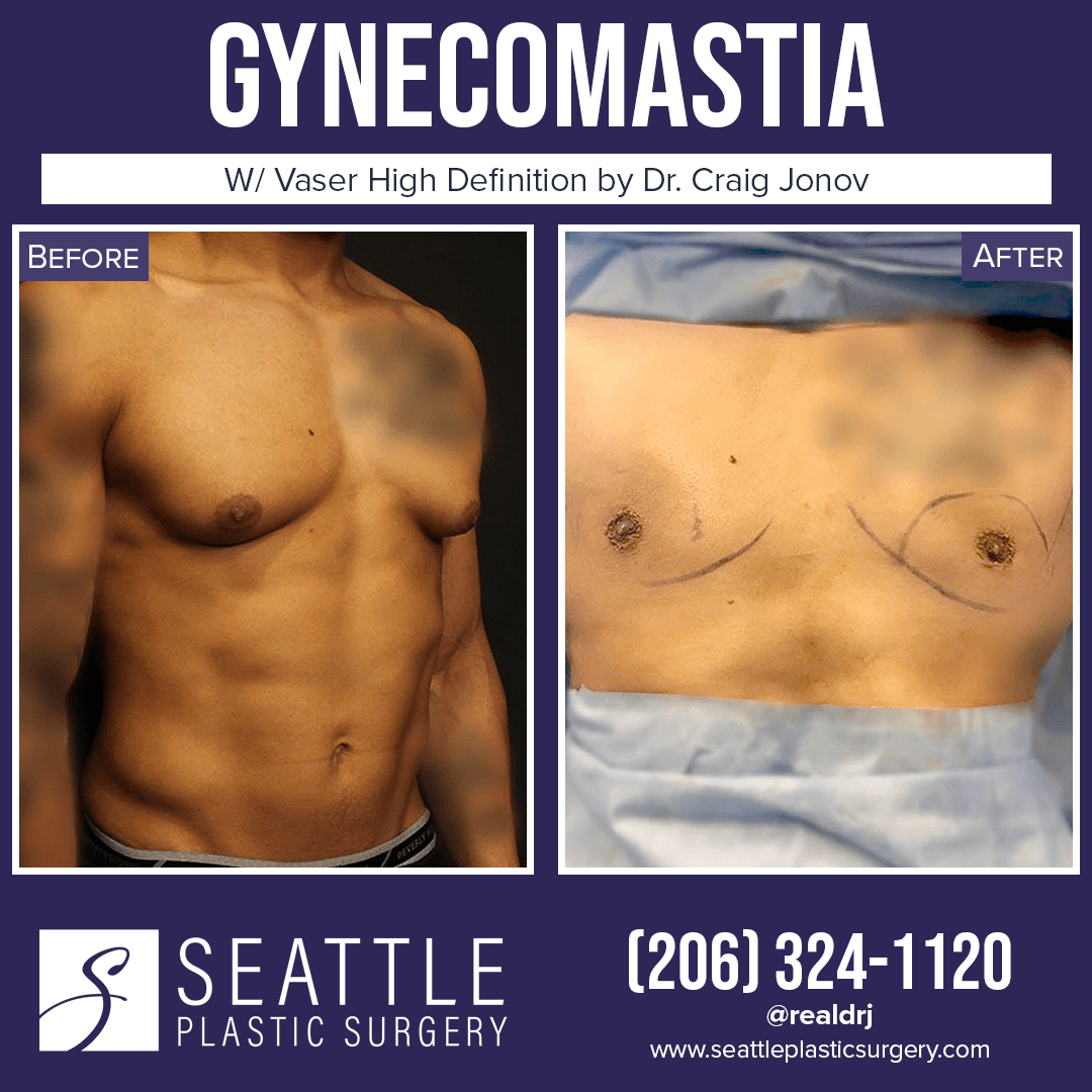 A Before and After Photo of a Plastic Surgery for Gynecomastia By Dr. Craig Jonov