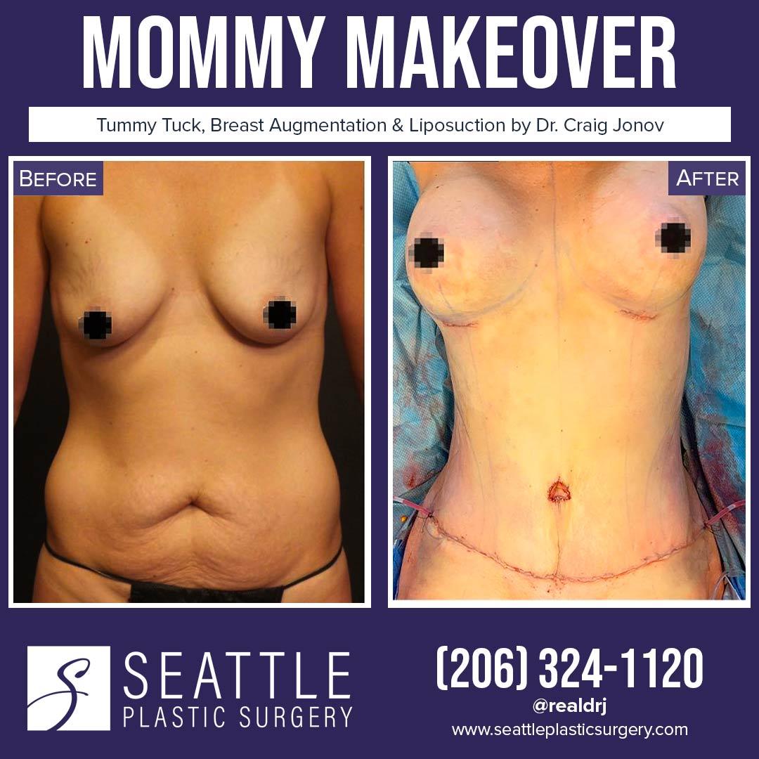 A Before and After photo of a Mommy Makeover Plastic Surgery by Dr. Craig Jonov