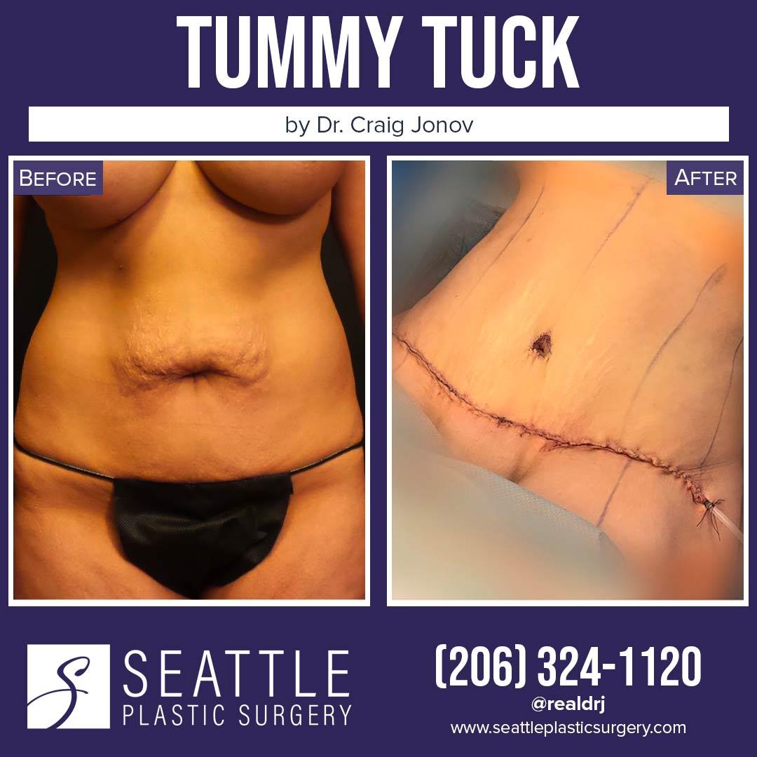 A Before and After photo of a Tummy Tuck Plastic Surgery by Dr. Craig Jonov