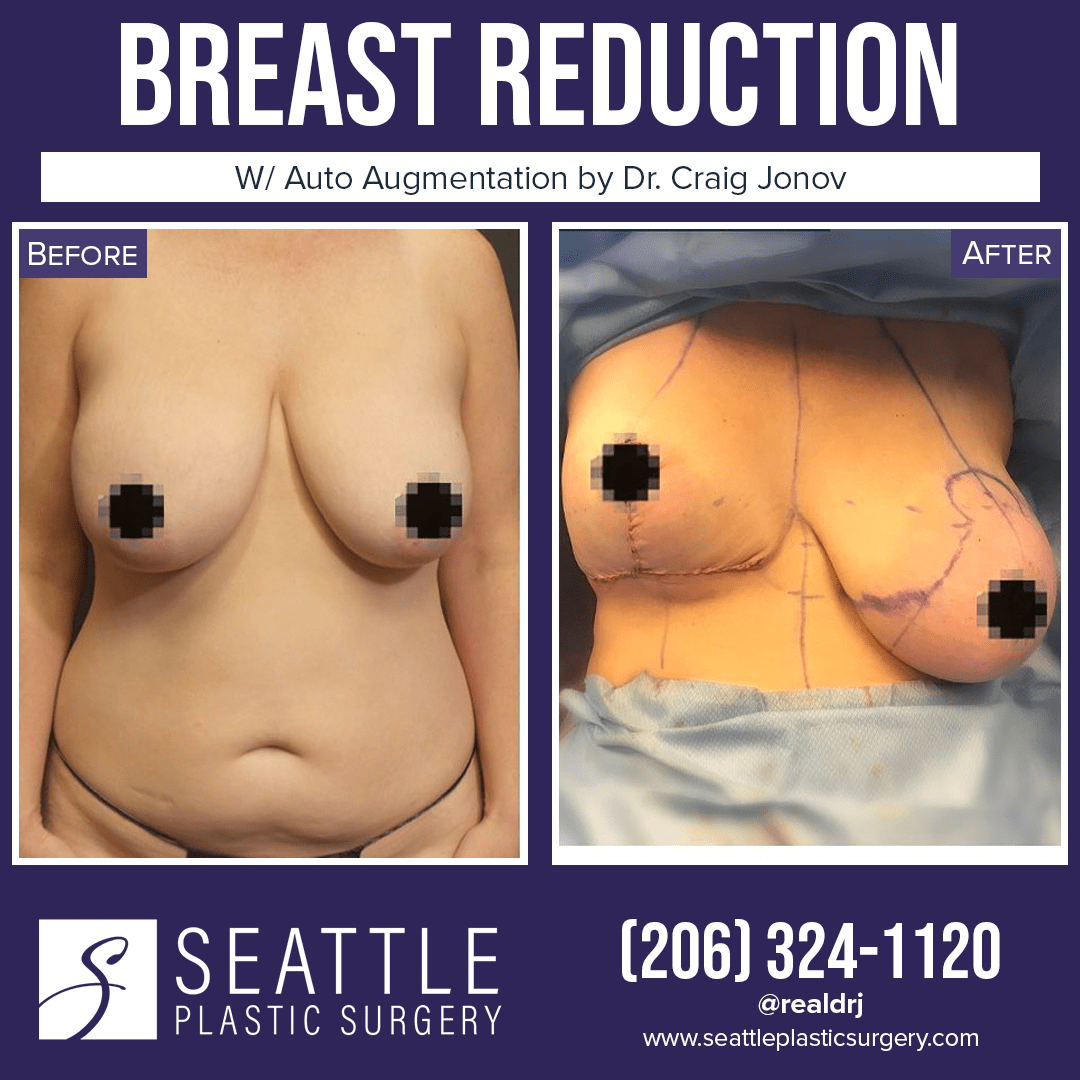 A Before and After photo of a Breast Reduction Plastic Surgery by Dr. Craig Jonov