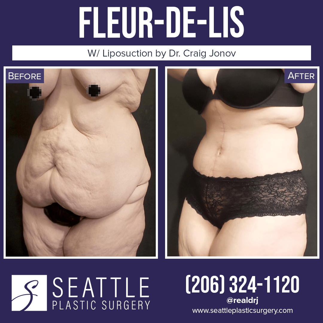 A Before and After photo of a Fleur-De-Lis Surgery With Liposuction by Dr. Craig Jonov